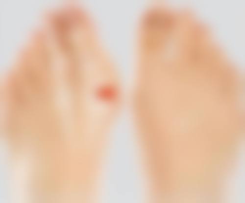 宝尼达隆鼻多久修复更好状态——6个月后迎来终极美丽时刻