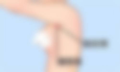 手臂吸脂皮肤弹性修复时间