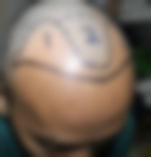 郑州曙光植发梅孟杰属于什么档次——圣丹福植发