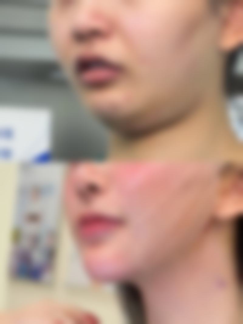 手臂吸脂疼痛修复时间