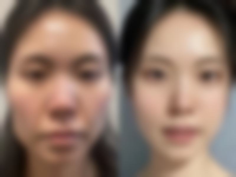 烫伤疤痕可以用芦荟胶吗？分级处理是关键