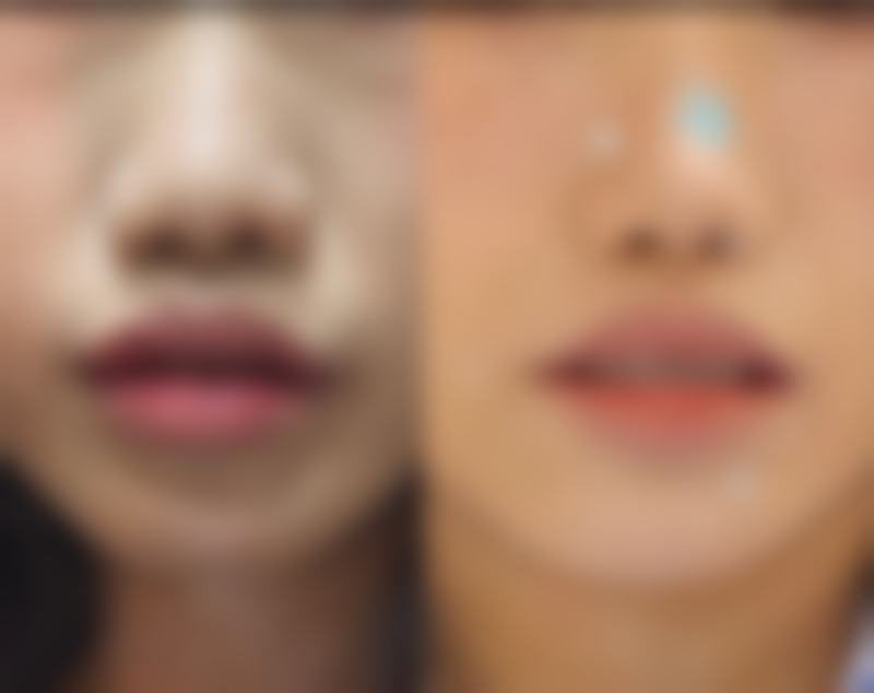 身体修复状况对隆胸手术时机的决定作用