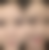 疤痕体质新旧疤痕的差异:时间并非万能的解药