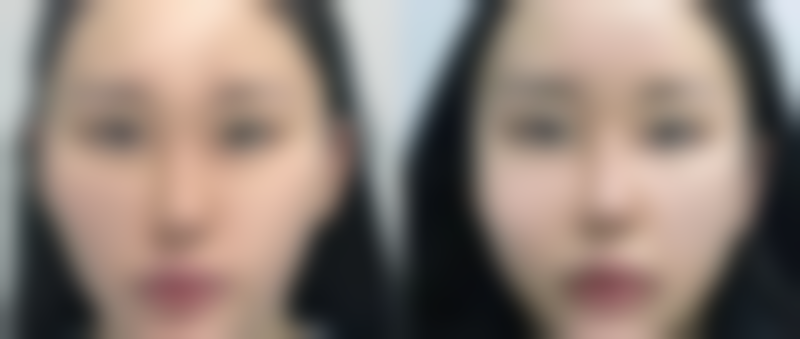 红色凹陷疤痕怎么消除：按摩技巧——手指间的修复魔法