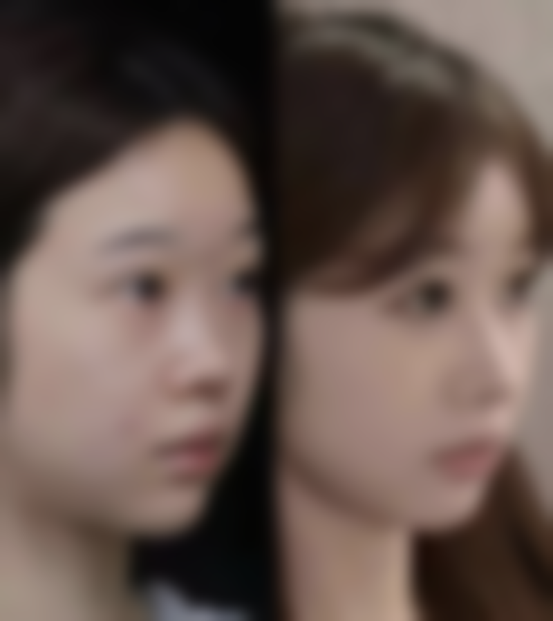 臀部吸脂减肥疼吗？术后护理+麻醉选择，北京上海三甲医院真实体验分享