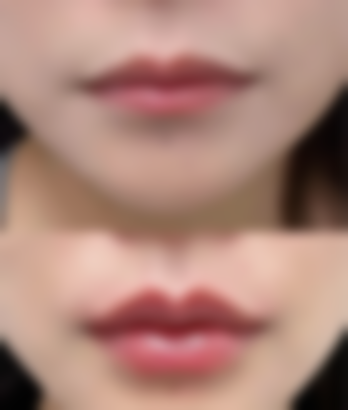 烫伤疤痕十几年了修复费用到底怎么算