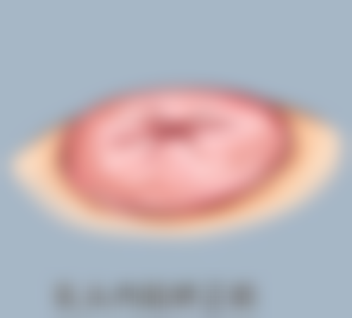 哪些人群适合北京三等甲医院的割双眼皮和割眼袋联合手术