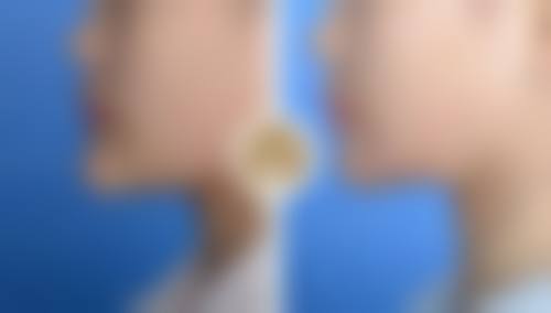 面部抽脂多久才能消肿：1 - 2周的“变脸”魔法