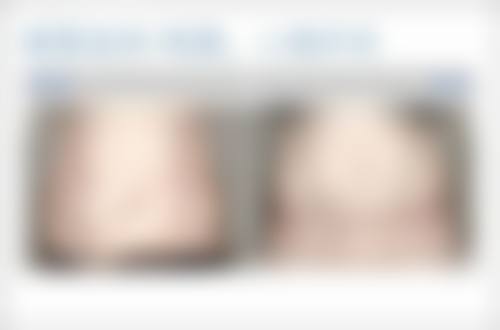 什么脸型打瘦脸针要谨慎——需精细微调的脸型