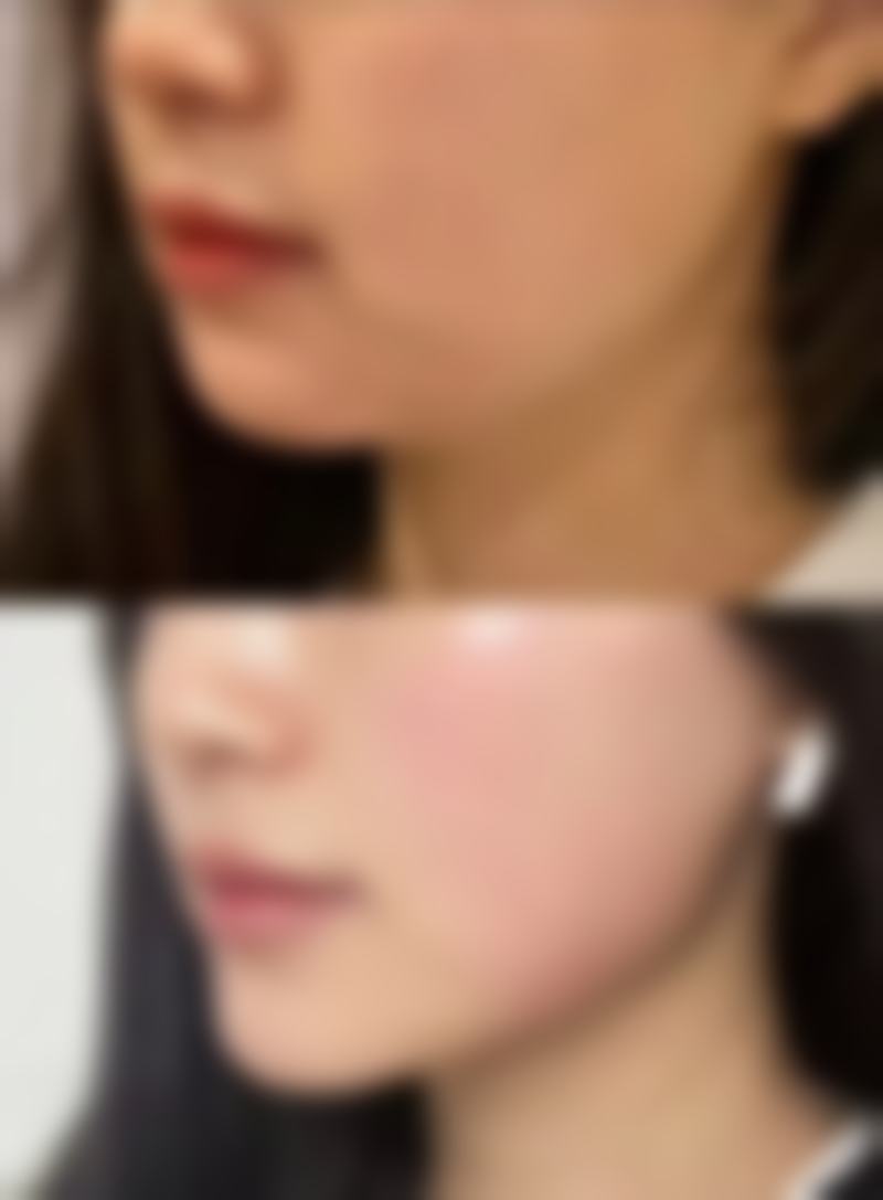 过来人的血泪经验:全切双眼皮用开刀吗背后的细节