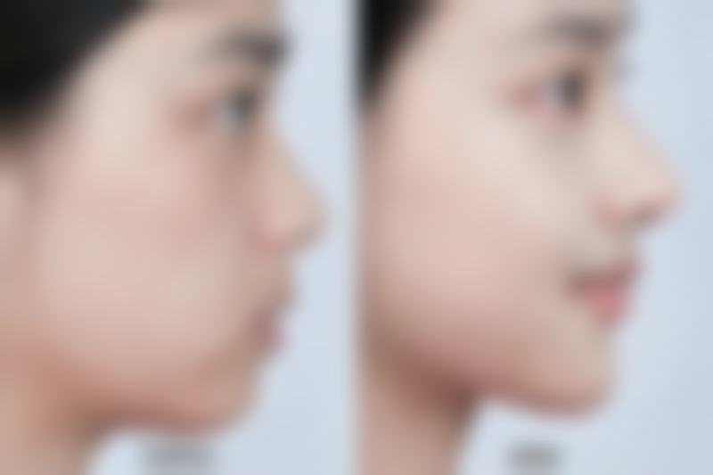 艾条去除眼袋的成效之真实评估