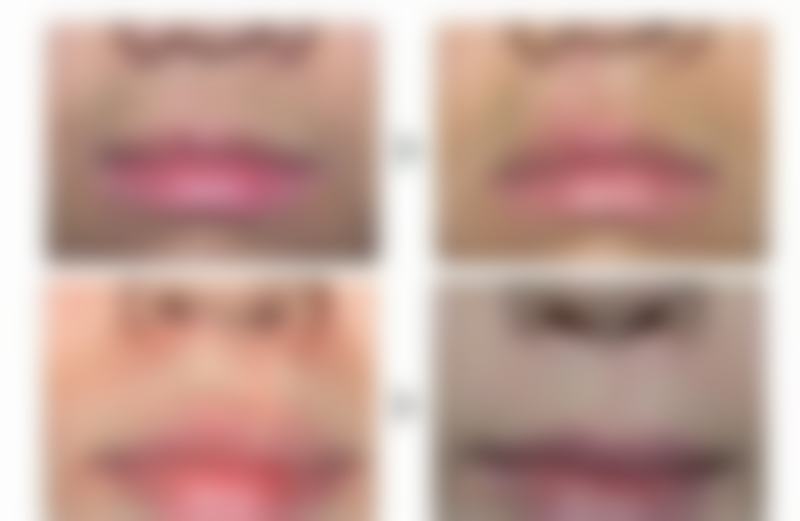 单侧大腿抽脂能瘦多少厘米？不对称问题的解决方案