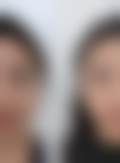 血压高能做眼袋手术吗:成功几率的数据真相