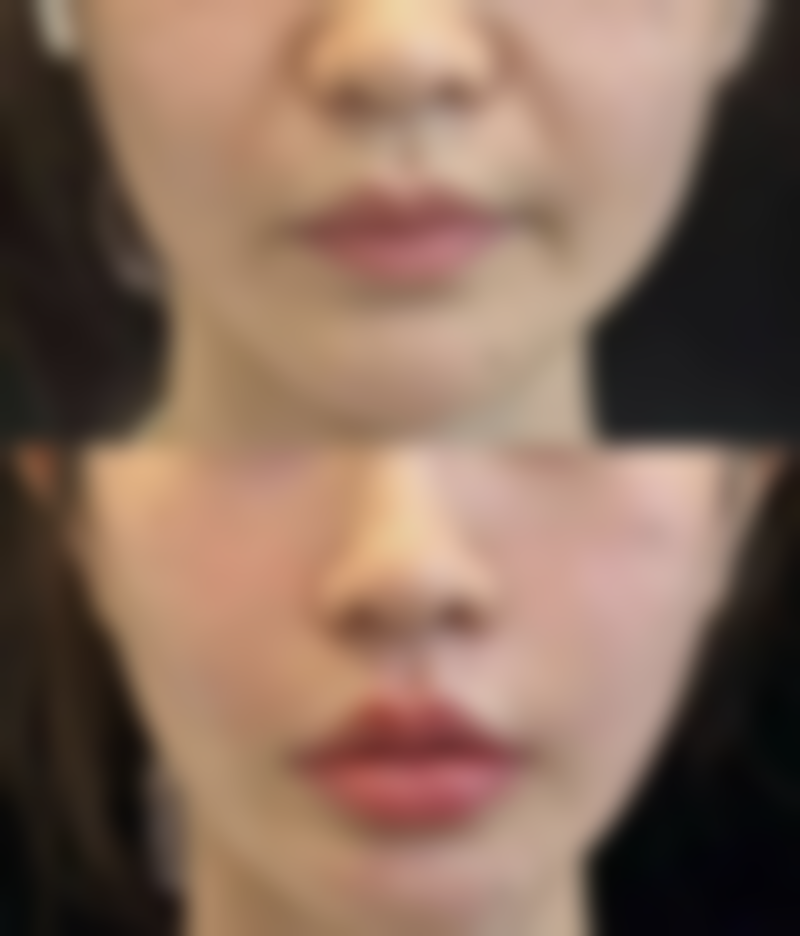 外切眼袋冰敷是起什么作用——冰敷后注意事项，助力理想修复