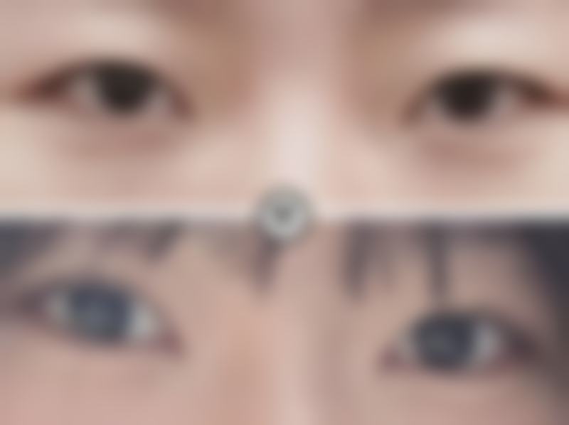 腰部抽脂多久才能消肿：为何修复如此缓慢