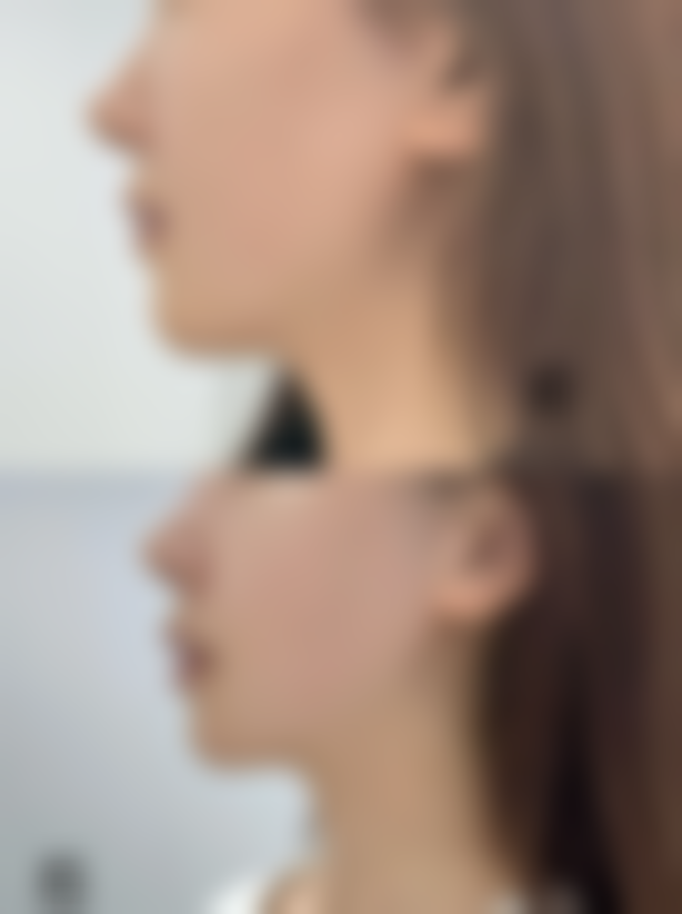 外切眼袋冰敷是起什么作用——常见问题解答，消除疑惑