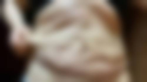 小针除皱与传统除皱方法性价比对比