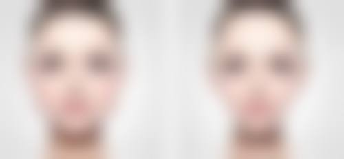 隆鼻打什么消炎针成效更好——氨基糖苷类与克林霉素类消炎针:特殊需求的定制之选