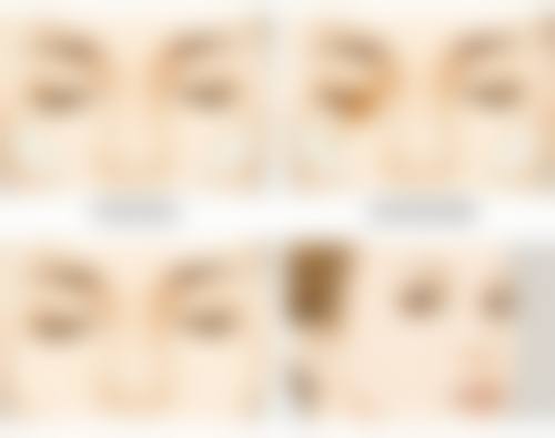 手术切除：疤痕疙瘩能长平的关键一步