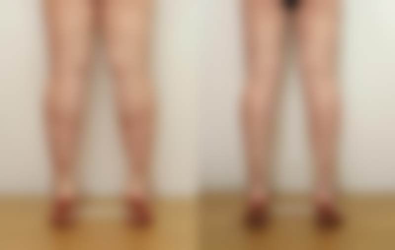 总结：韩国李敬秀纤腓针值得拥有