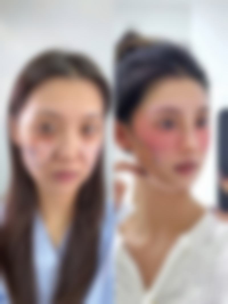 影响小针除皱成效的因素大盘点