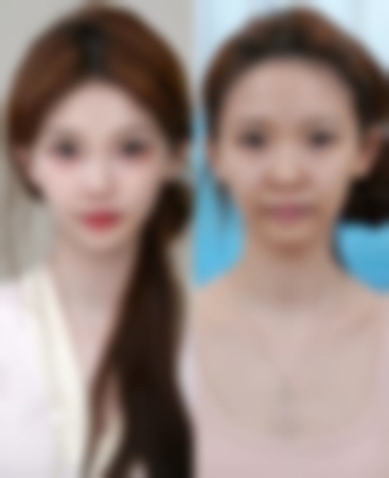 做脸部吸脂，必须知道的副作用