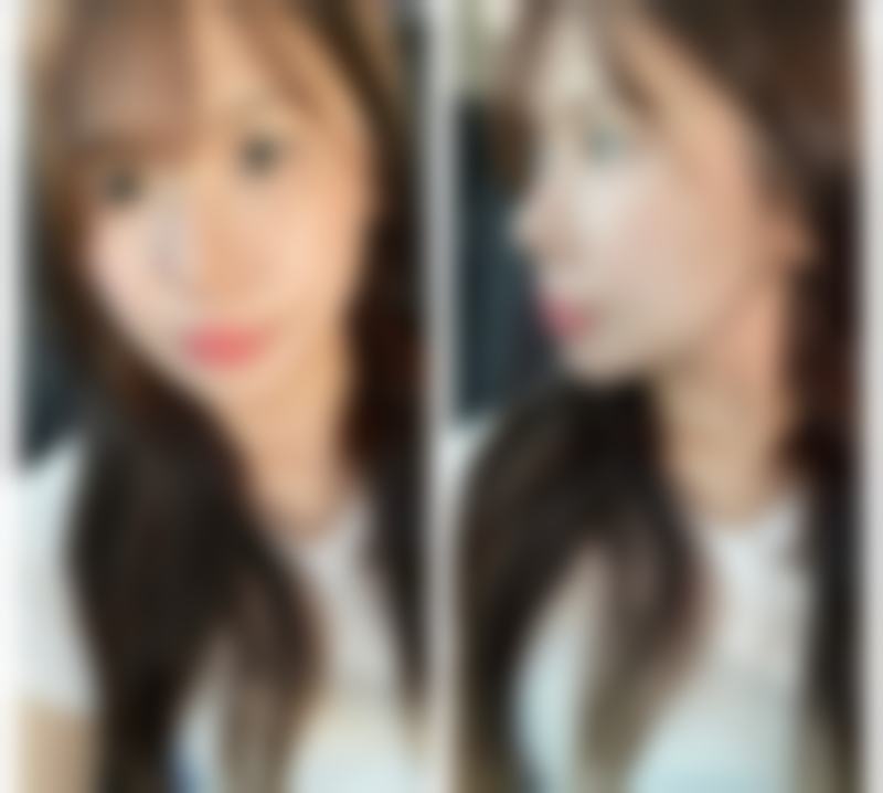 北京伊美尔紫竹医疗美容门诊部顾客实例