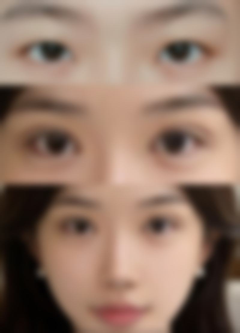 面部疤痕黑印会自然淡化吗