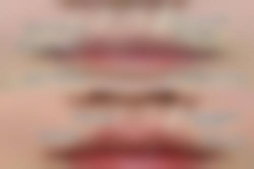 做完眼袋出现重度疤痕增生可以下去吗