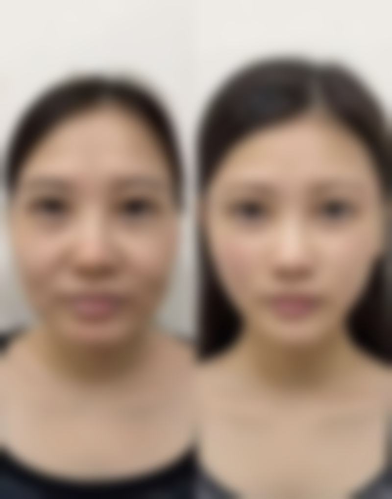 后天眼袋成都手术去除：投资美丽的成本分析