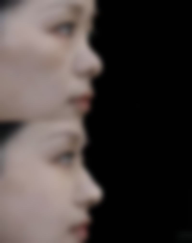 哪些手术可以去眼袋——激光法：无创科技的温柔奇迹