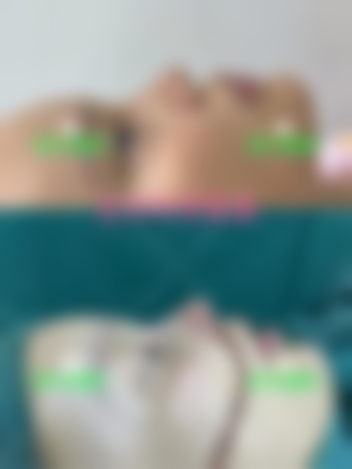 济南海峡整形4000元乔雅登玻尿酸顾客实例