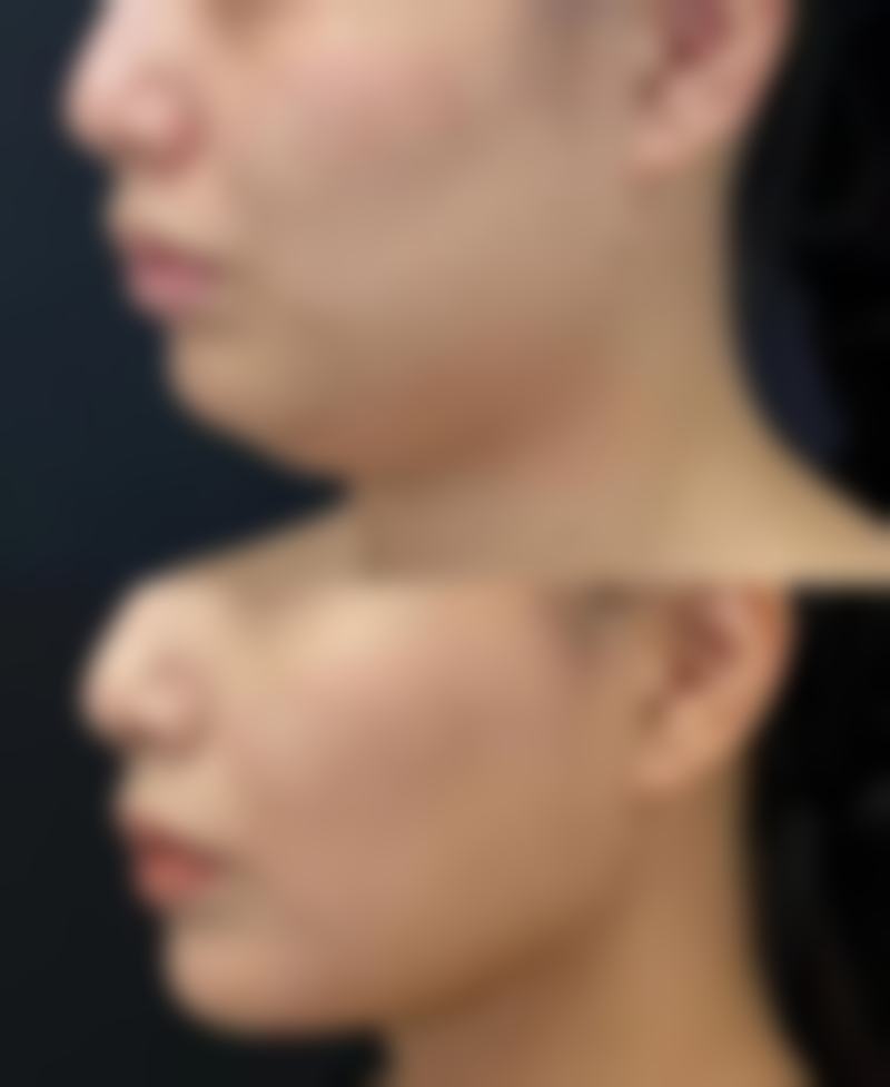 埋线双眼皮医生哪好之具有影响力骨干医生推荐指南