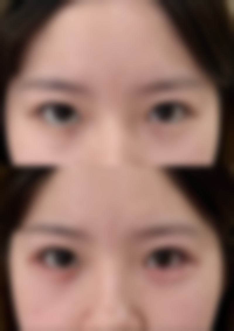 全切双眼皮手术哪好之持久成效医院探寻
