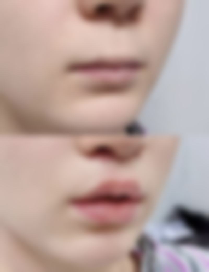 怎么可以让三眼皮变回双眼皮:何时考虑手术治疗