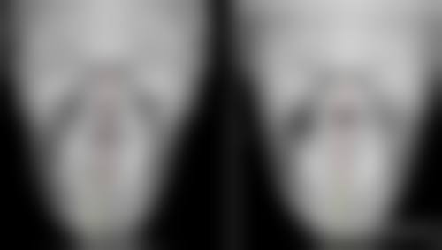 减肥后出现眼袋怎么办之预防胜于治疗