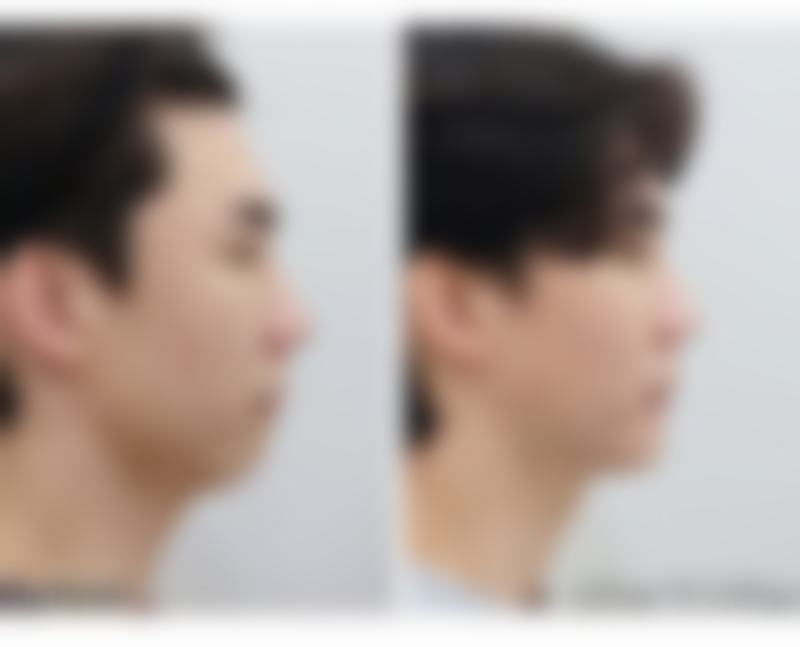 面部、手臂、背部和臀部吸脂一个半月还能瘦吗?各部位修复大揭秘