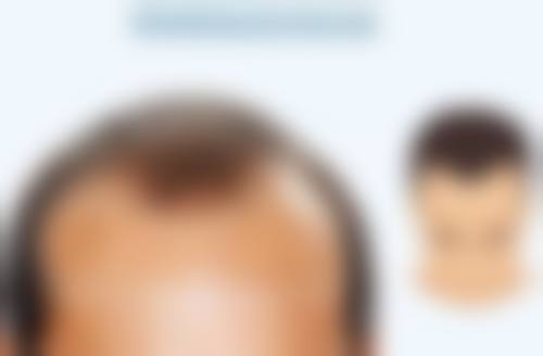 专精皮肤科医院手术疤痕增生个性化修复：精细定制