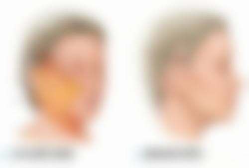 七、瘦脸针成效可以持续多久之多次注射影响