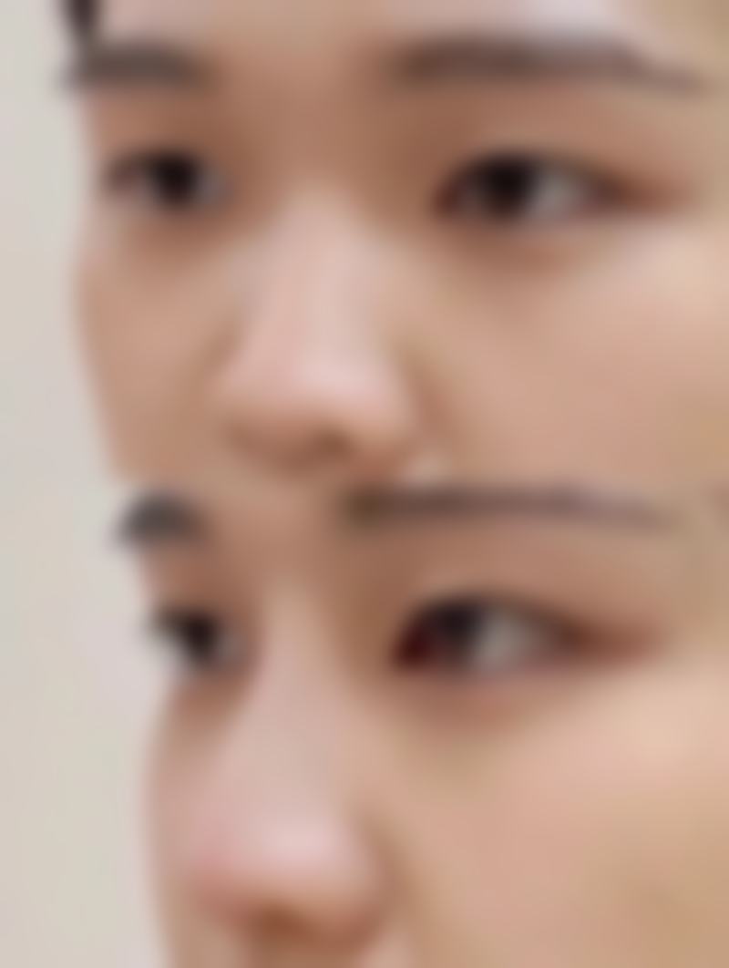 黑眼圈和眼袋怎去除——手术治疗的全方面解析