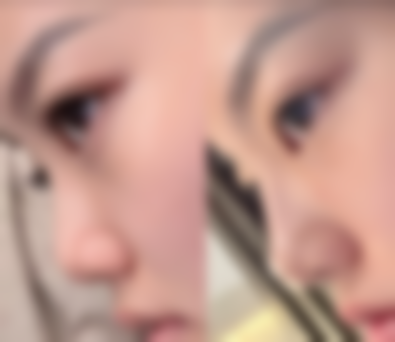 四、瘦脸针成效可以持续多久之个人体质影响