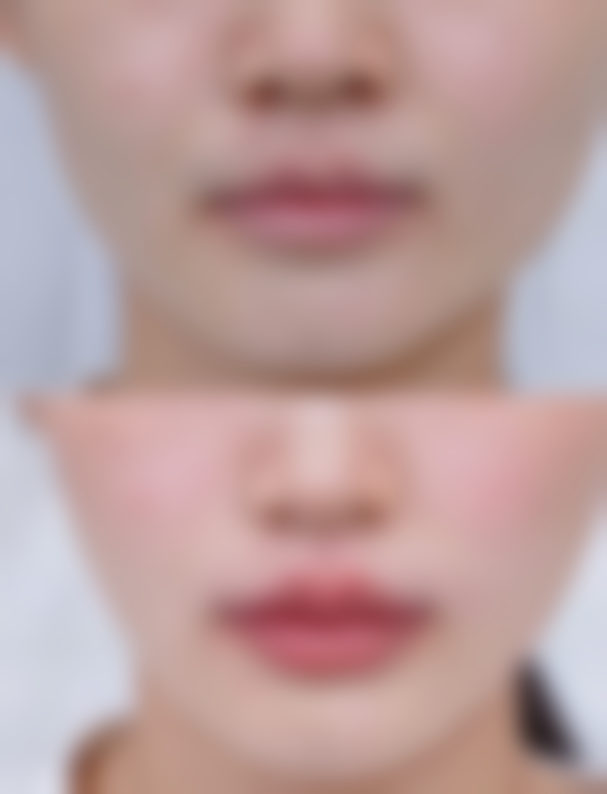 额头摔伤缝针的疤痕怎么去——预防胜于治疗：提前做好防范措施