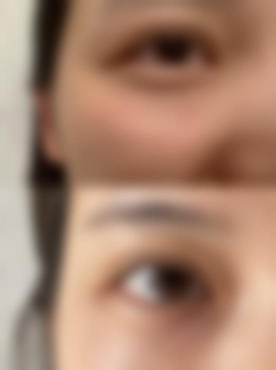 腿部抽脂有危害吗之术后护理全攻略：细节决定修复成效