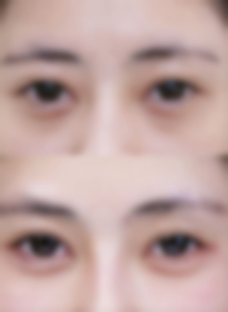 腿部抽脂有危害吗之致命风险：脂肪栓塞背后的危机