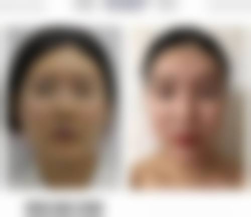 祛眼袋的日常护理建议