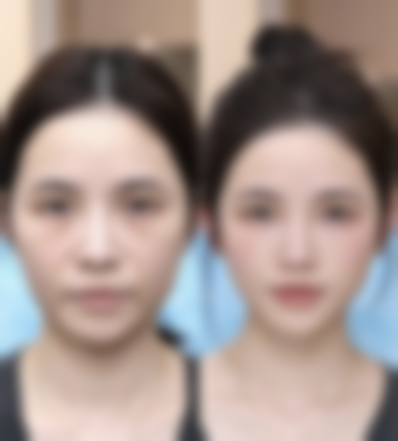 割了双眼皮肿得厉害，冰敷就是“救星”啊