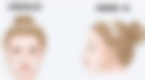 注射骨粉隆鼻有什么副作用——变形：时间刻下的“丑陋印记”