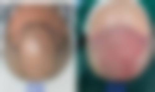 董新波医生简介做手术价格