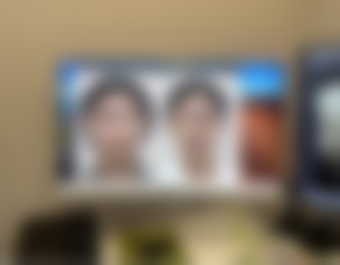 注射骨粉隆鼻有什么副作用——肉芽肿：鼻子里的“顽固不速之客”