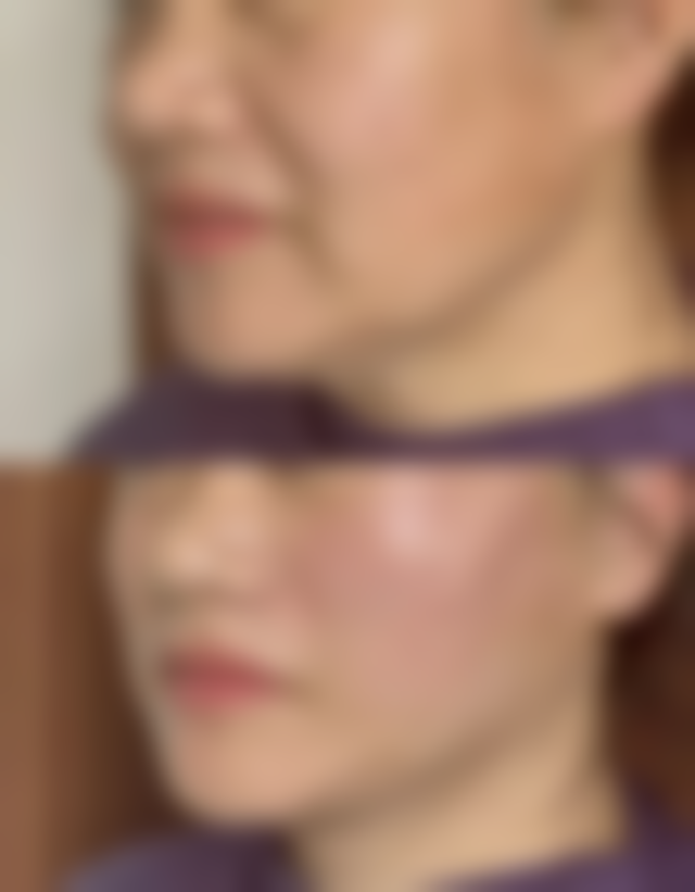 注射骨粉隆鼻有什么副作用——过敏：身体对“外来客”的强烈抗议